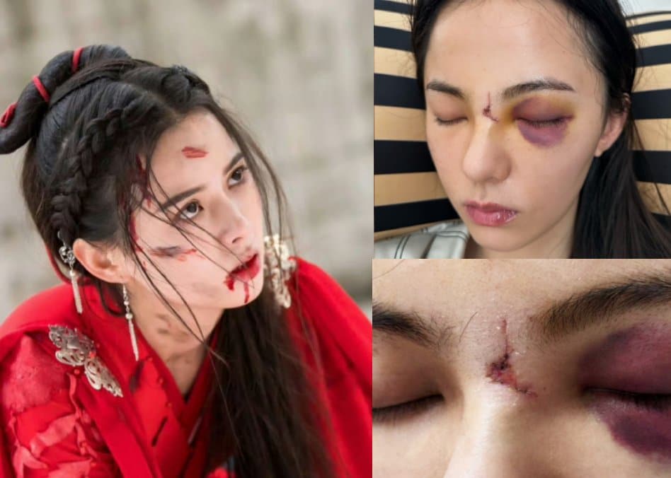 Хуан Жи Ин в ответ на критику о том, что раздула популярность сообщениями о травме лица, опубликовала фото из больницы
